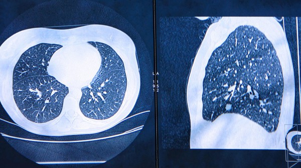 圖1 : ERS在國際大會上發表的研究結果。人工智慧有機會能夠比傳統的CT掃描提早一年檢測出肺癌。(source:European Respiratory Society)
