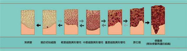 圖2 : 形成惡性腫瘤前的細胞變異過程(source:NCI Division of Cancer Prvention)